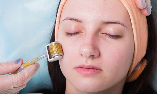What Is Microneedling? – Know About Procedure, Benefits, Effects, and More
