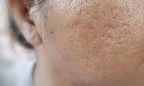 Tips for Preventing Acne Scars