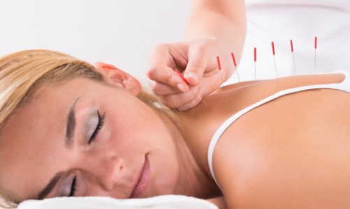 Different types of acupuncture treatments