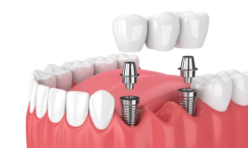 Implant-retained bridges vs. dentures