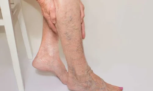 Top Causes of Spider Veins 