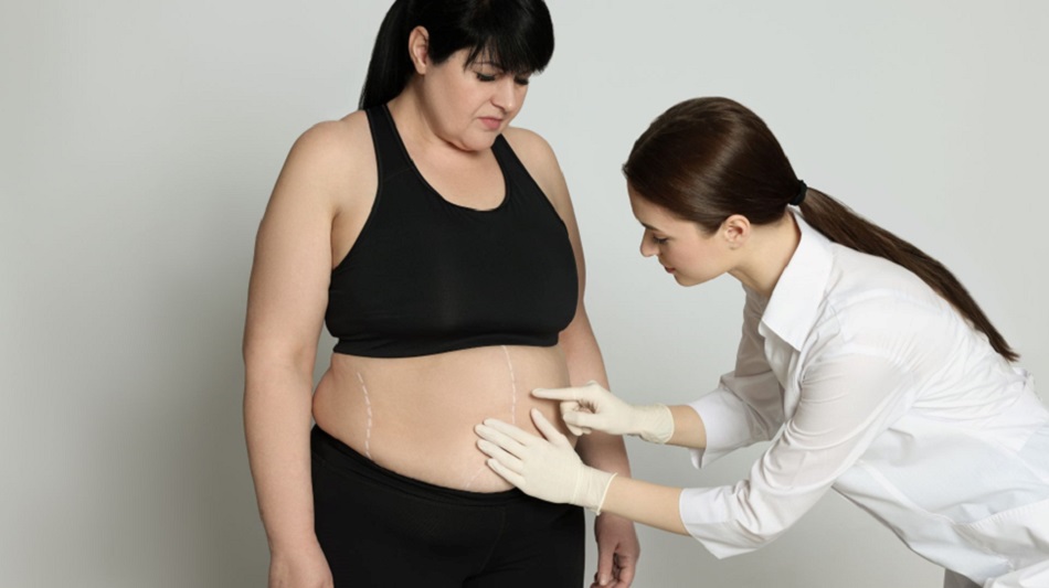 Weight-Loss Post-Bariatric Surgery