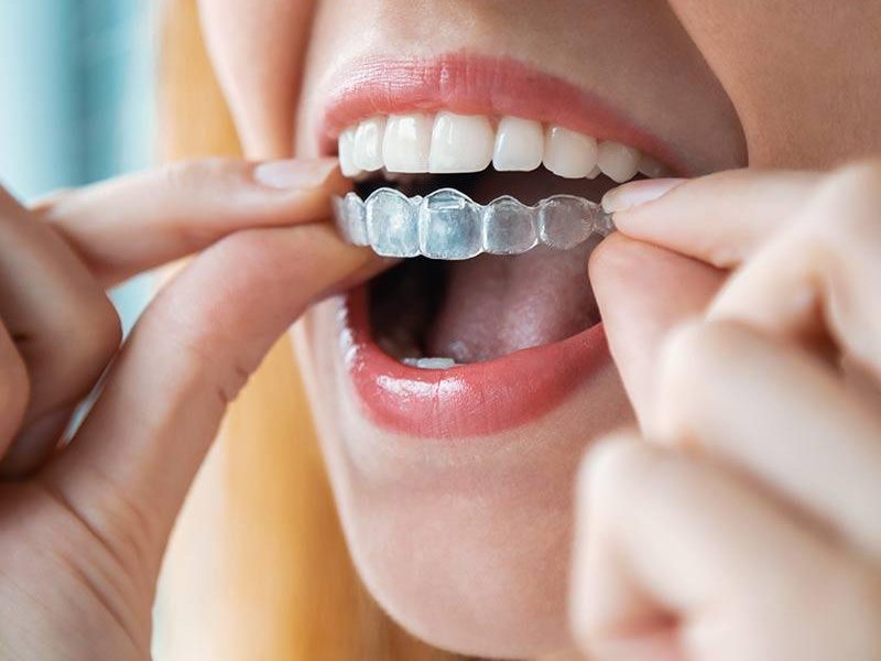 Invisalign: What Is It?