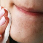 Blackheads the Gentle Way